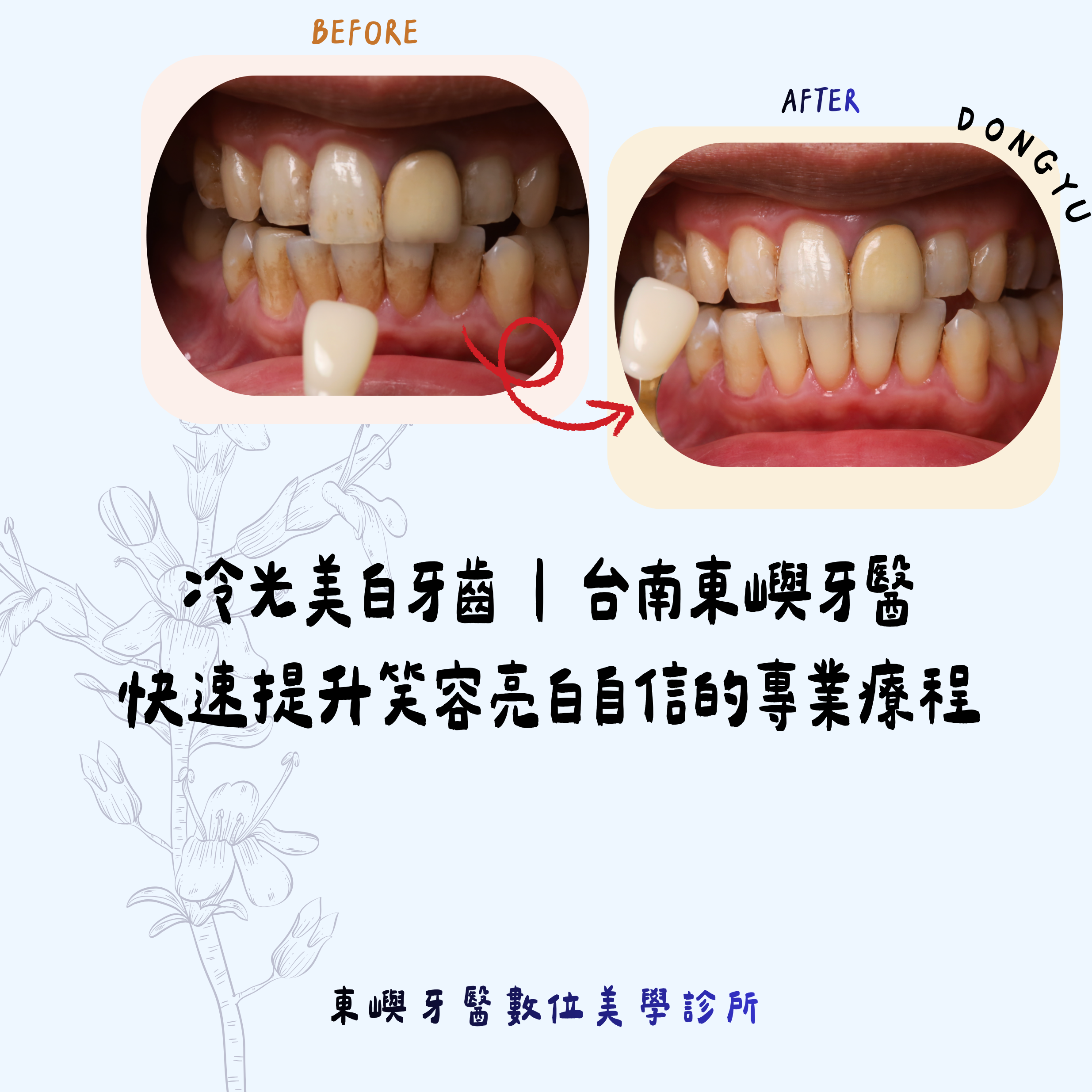 冷光美白牙齒 ｜ 台南東嶼牙醫 快速提升笑容亮白自信的專業療程縮圖