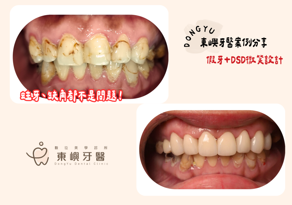 前牙蛀牙重建前後對照 東嶼牙醫2