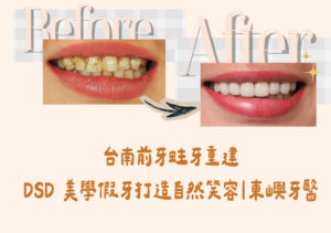 台南前牙蛀牙重建 DSD 美學假牙打造自然笑容｜東嶼牙醫 封面