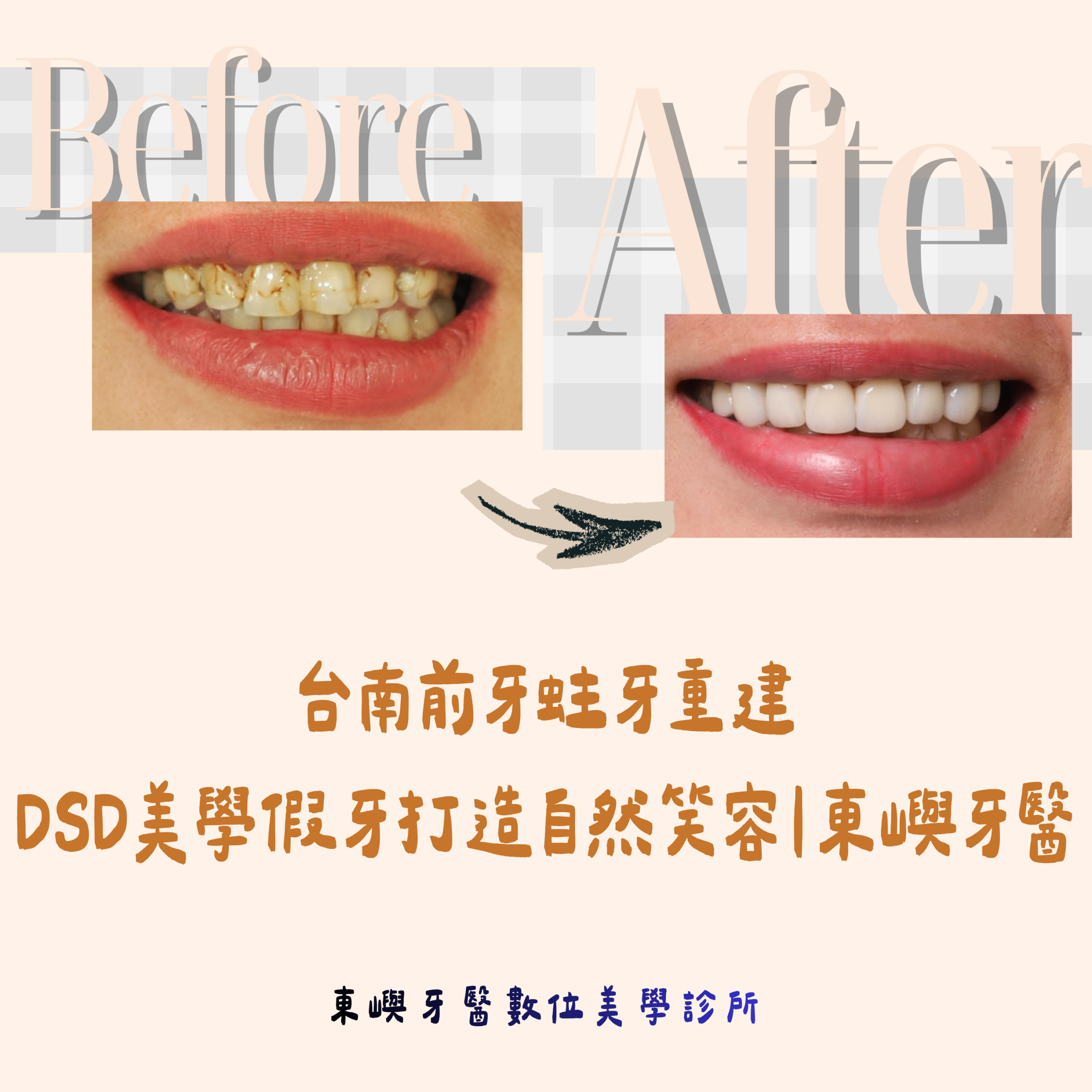 台南前牙蛀牙重建 DSD美學假牙打造自然笑容｜東嶼牙醫 縮圖