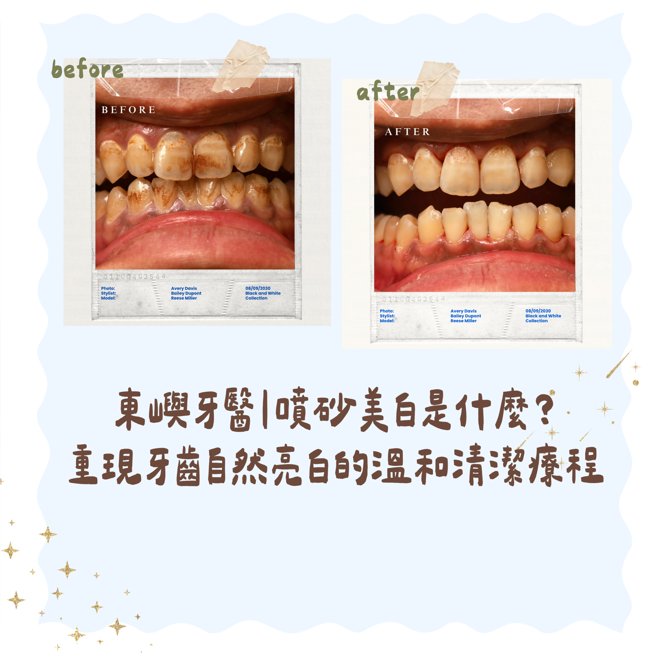 東嶼牙醫｜噴砂美白是什麼？ 重現牙齒自然亮白的溫和清潔療程縮圖