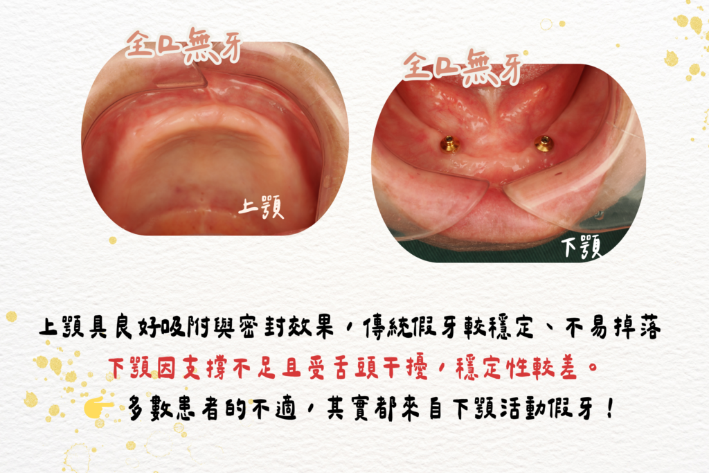 80 多歲患者活動假牙一直掉的治療評估與鈕扣式活動假牙案例