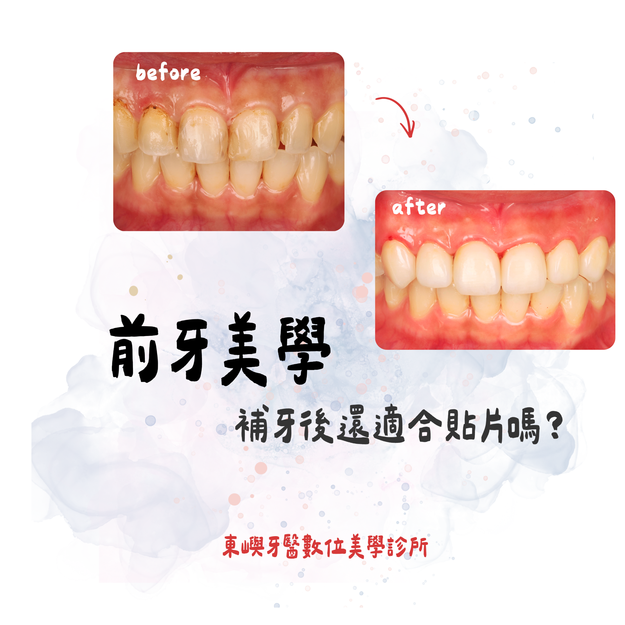 前牙多次補牙後評估陶瓷貼片或牙冠重建的案例封面