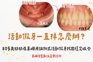 活動假牙一直掉怎麼辦？80多歲奶奶在東嶼用鈕扣式活動假牙找回穩定咬合封面