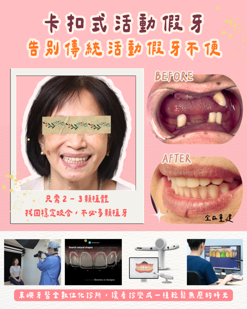 卡扣式活動假牙 告別傳統活動假牙不便