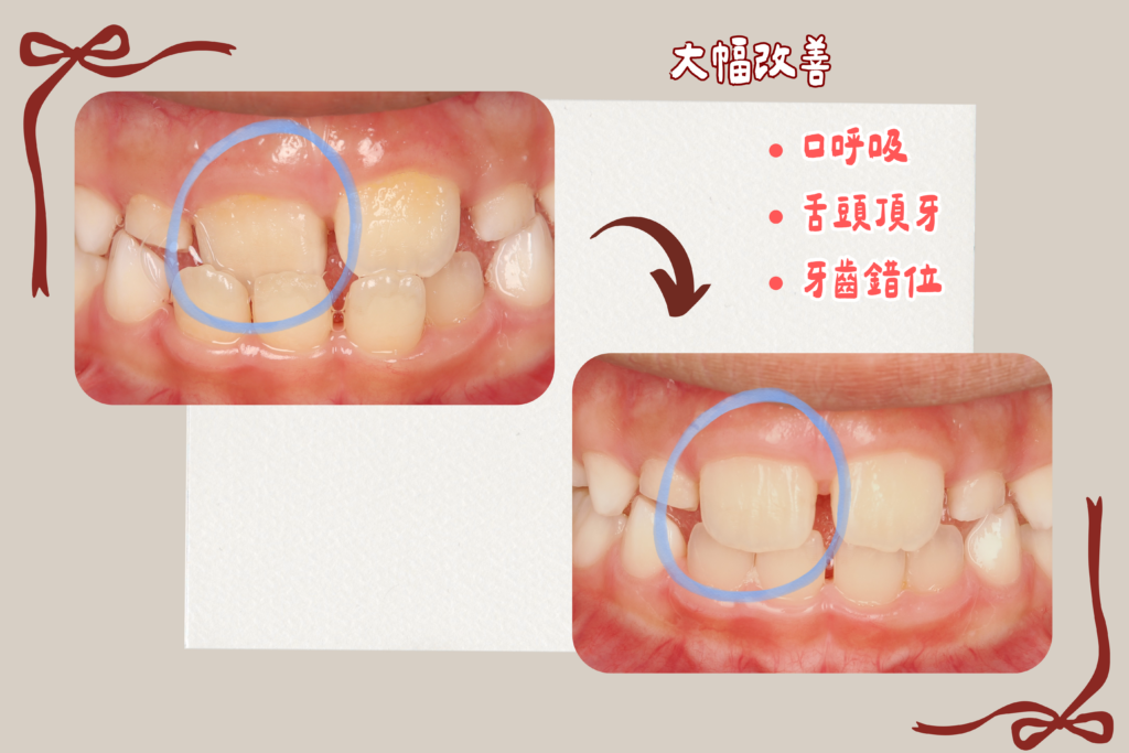 東嶼牙醫早期矯正case1