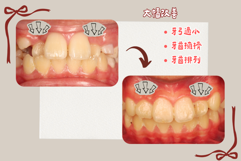 東嶼牙醫早期矯正case2