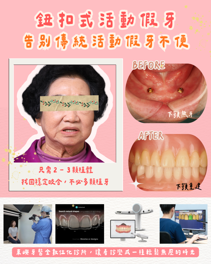 鈕扣式活動假牙 告別傳統活動假牙不便