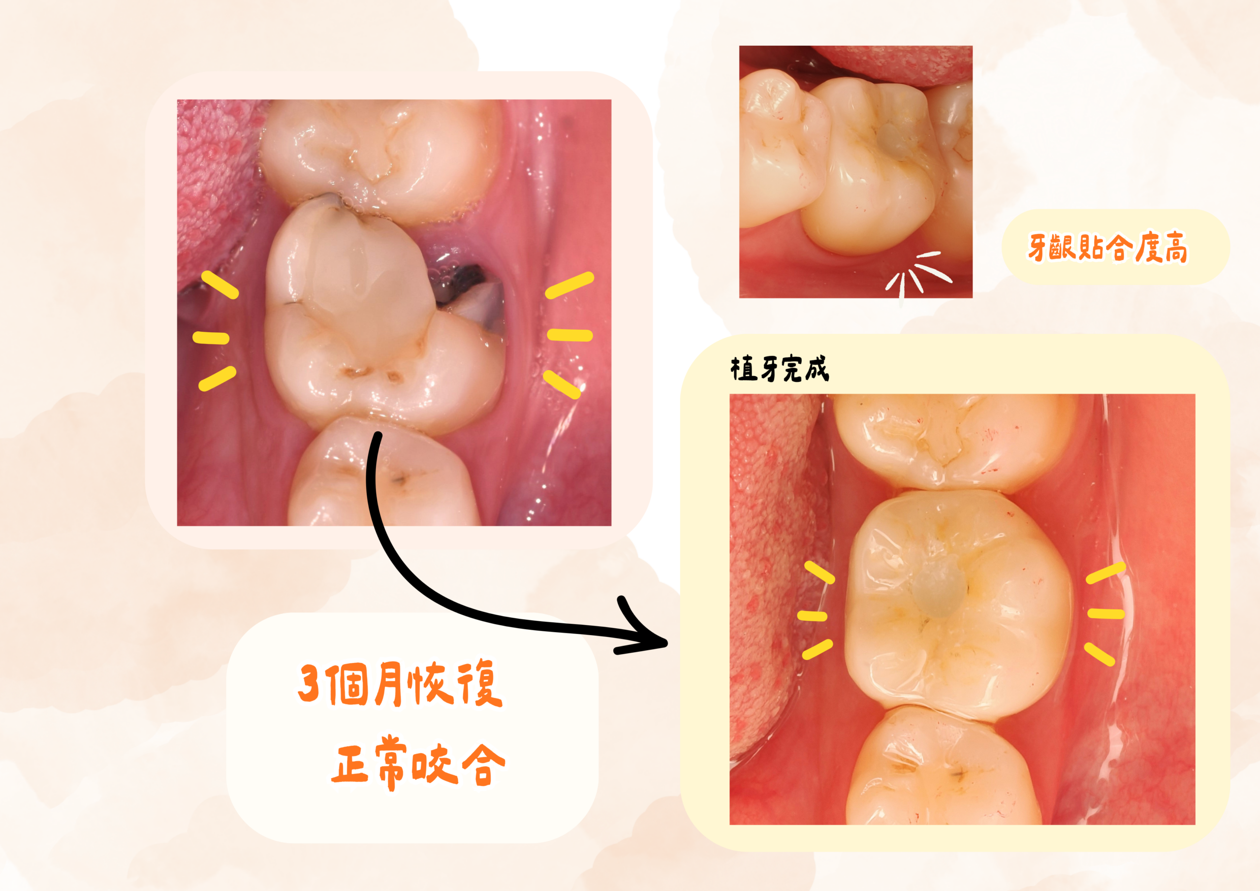 東嶼牙醫即拔即植前後對照實際案例
