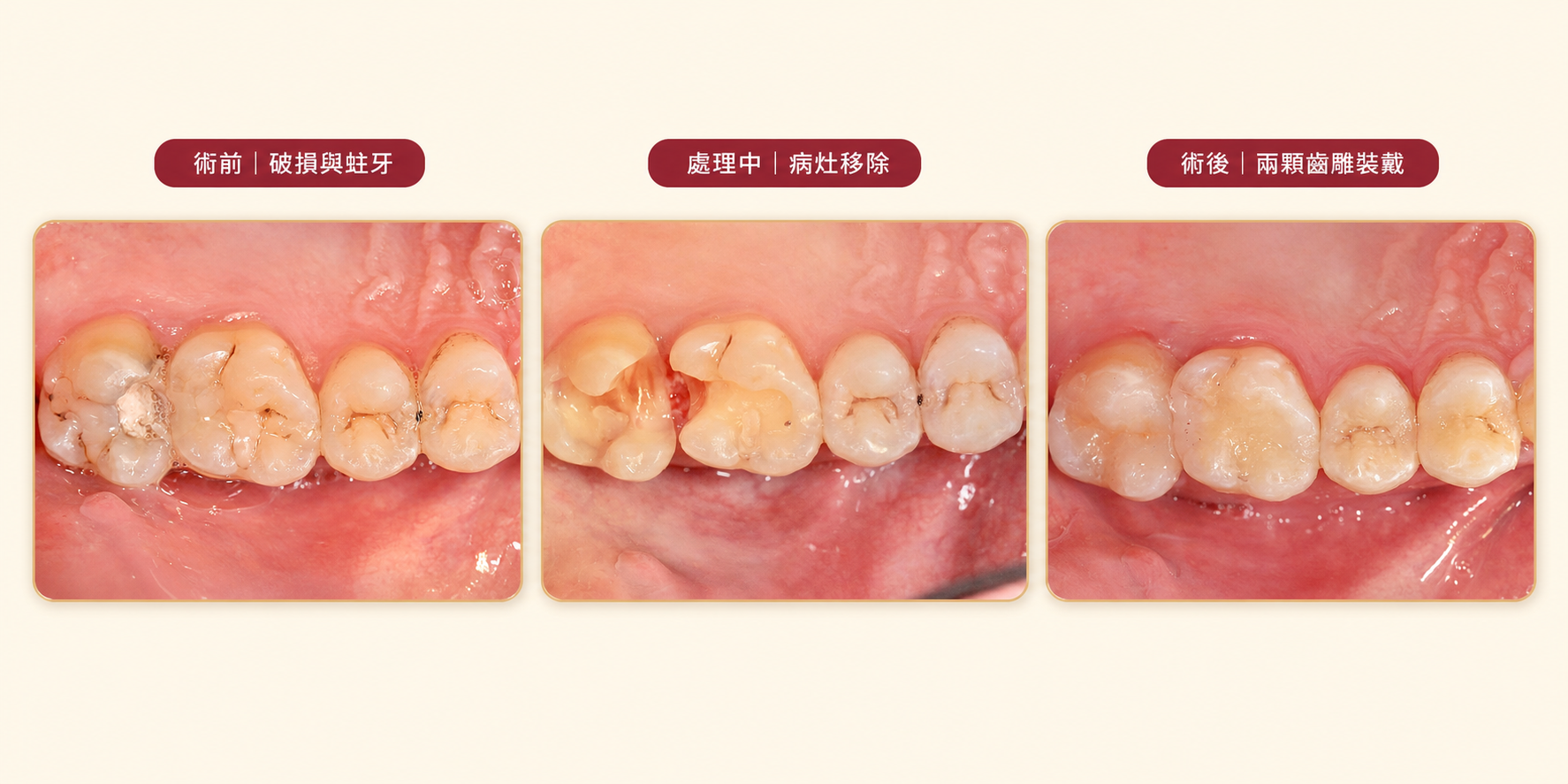 兩顆後牙3D全瓷齒雕案例