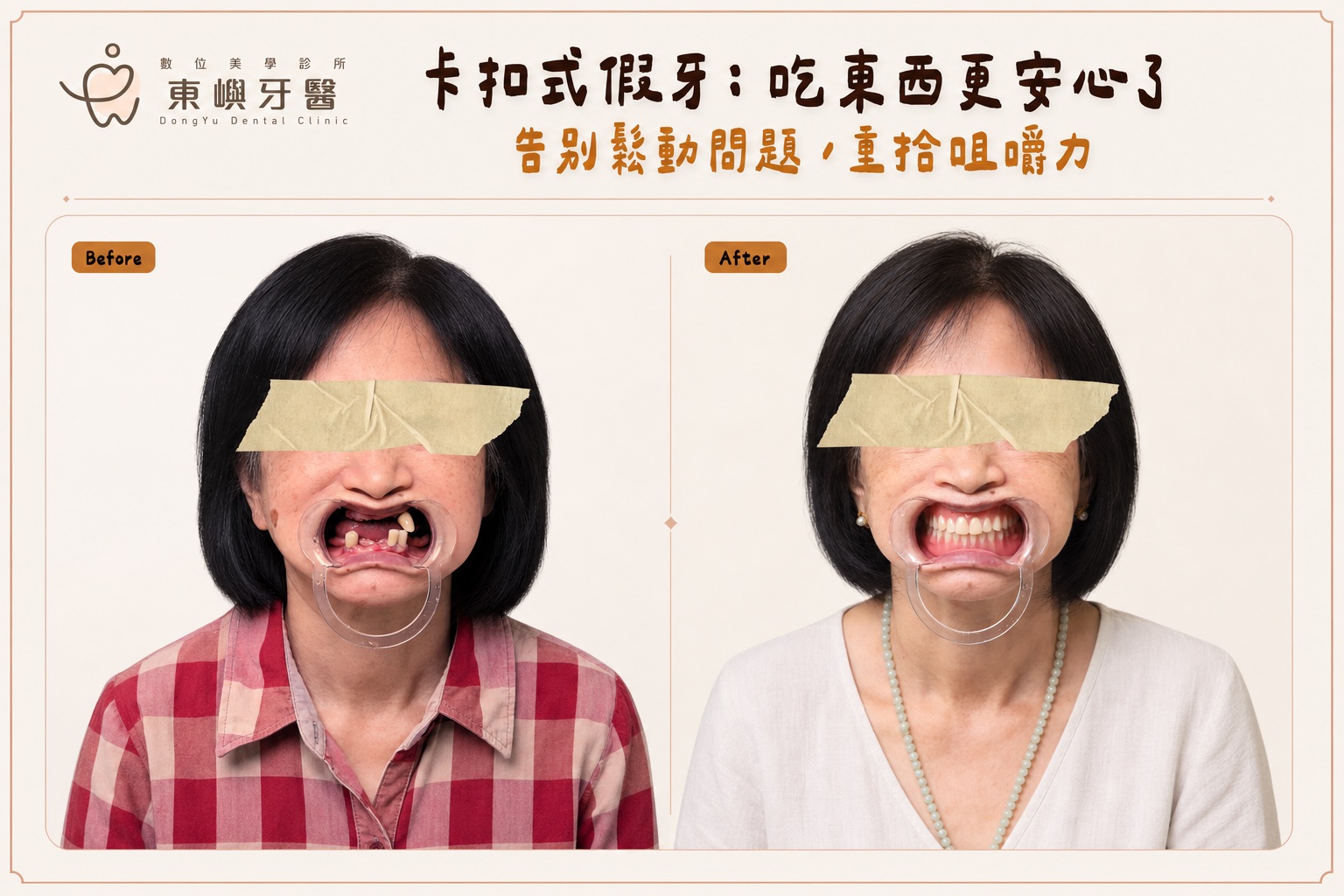 卡扣式活動假牙案例配戴前後臉部與微笑紀錄