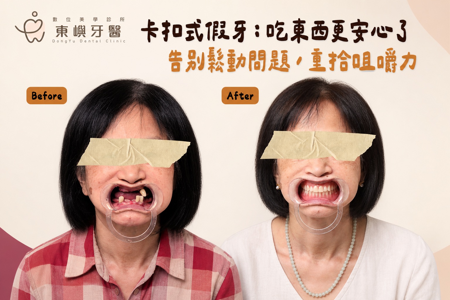 卡扣式活動假牙改善鬆動案例
