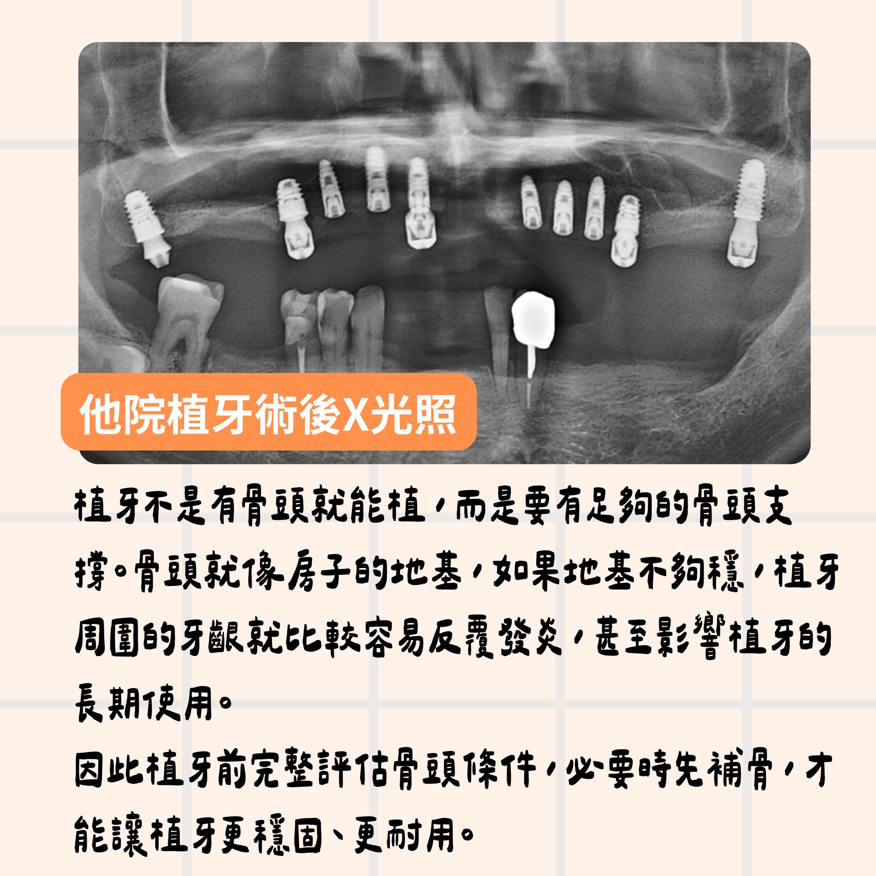 台南植牙重建案例，患者到東嶼牙醫初診時的全口植牙 X 光影像