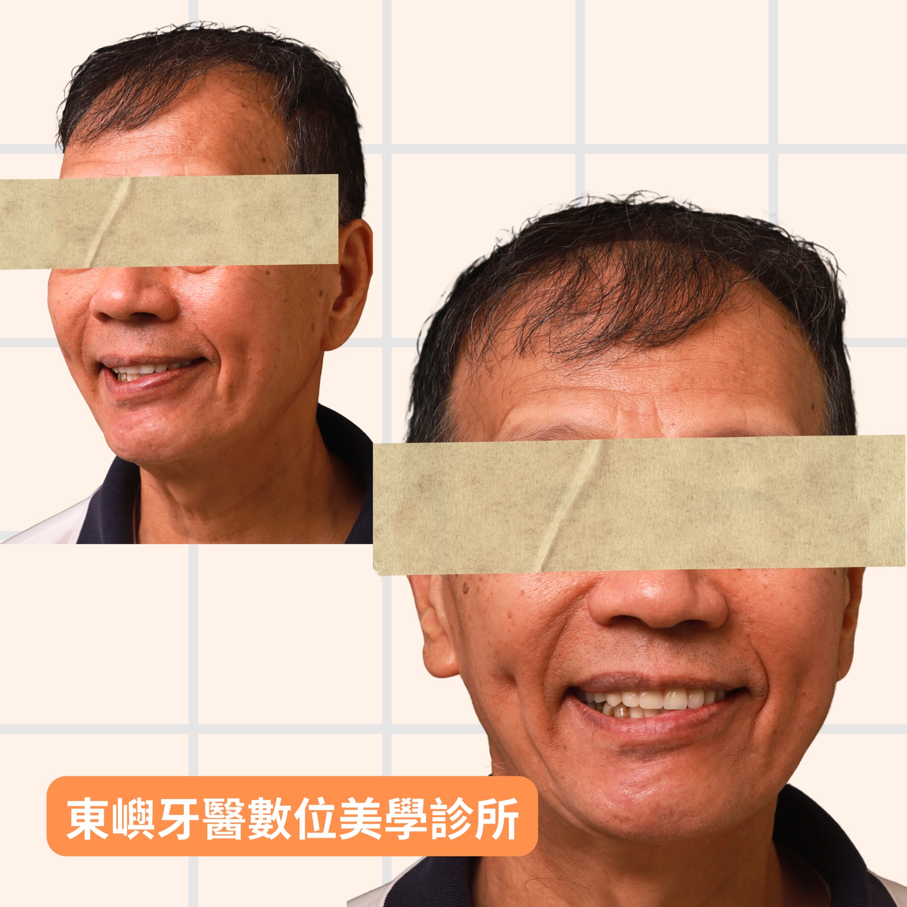台南卡扣式活動假牙全口重建完成後，患者配戴假牙的微笑照片