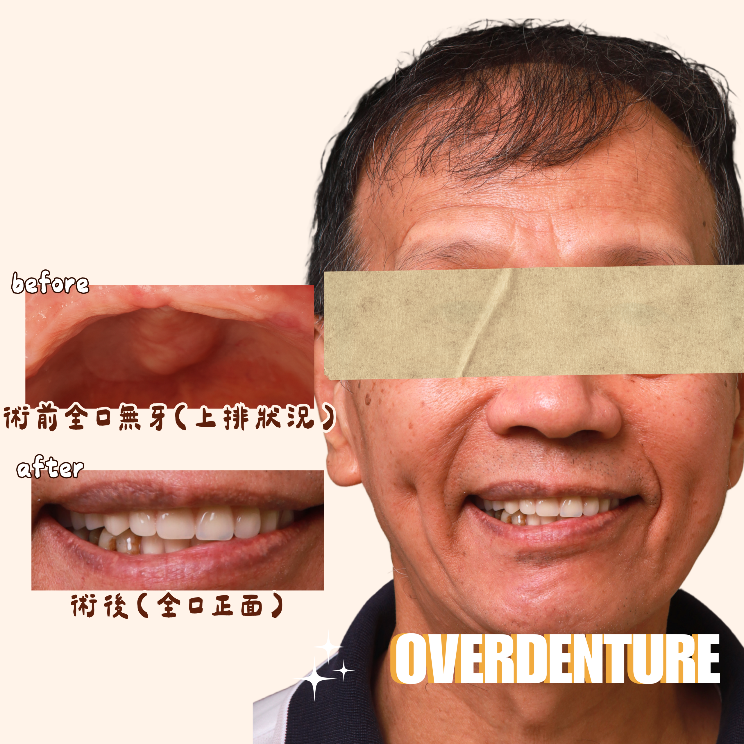 台南卡扣式活動假牙全口重建完成後，患者配戴假牙的微笑照片
