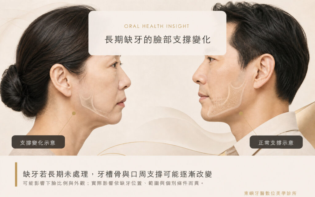長期缺牙可能造成顎骨與口周支撐變化示意｜東嶼牙醫數位美學診所