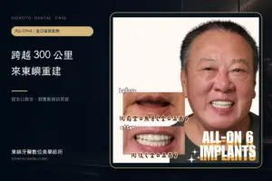台南全口重建｜跨越 300 公里 All-on-6 真實案例封面｜東嶼牙醫數位美學診所
