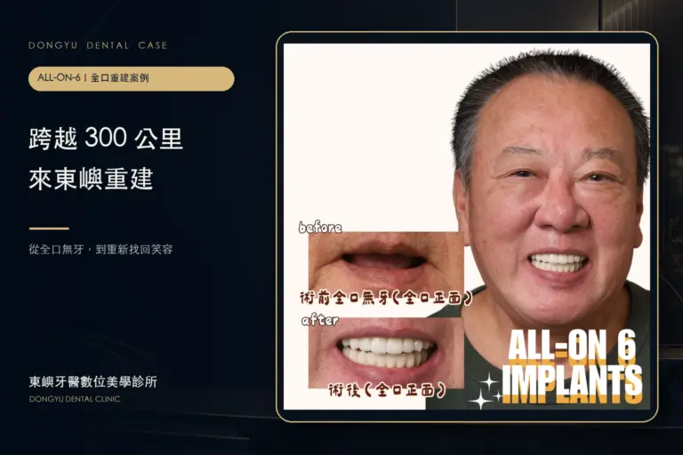 台南全口重建｜跨越 300 公里 All-on-6 真實案例封面｜東嶼牙醫數位美學診所
