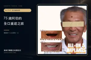 All-on-5 重建｜75 歲阿伯缺牙到有牙真實案例封面｜東嶼牙醫數位美學診所