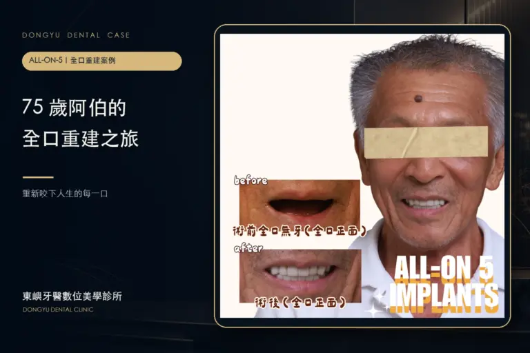 All-on-5 重建｜75 歲阿伯缺牙到有牙真實案例封面｜東嶼牙醫數位美學診所