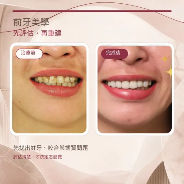 前牙蛀牙美學重建治療前後對照