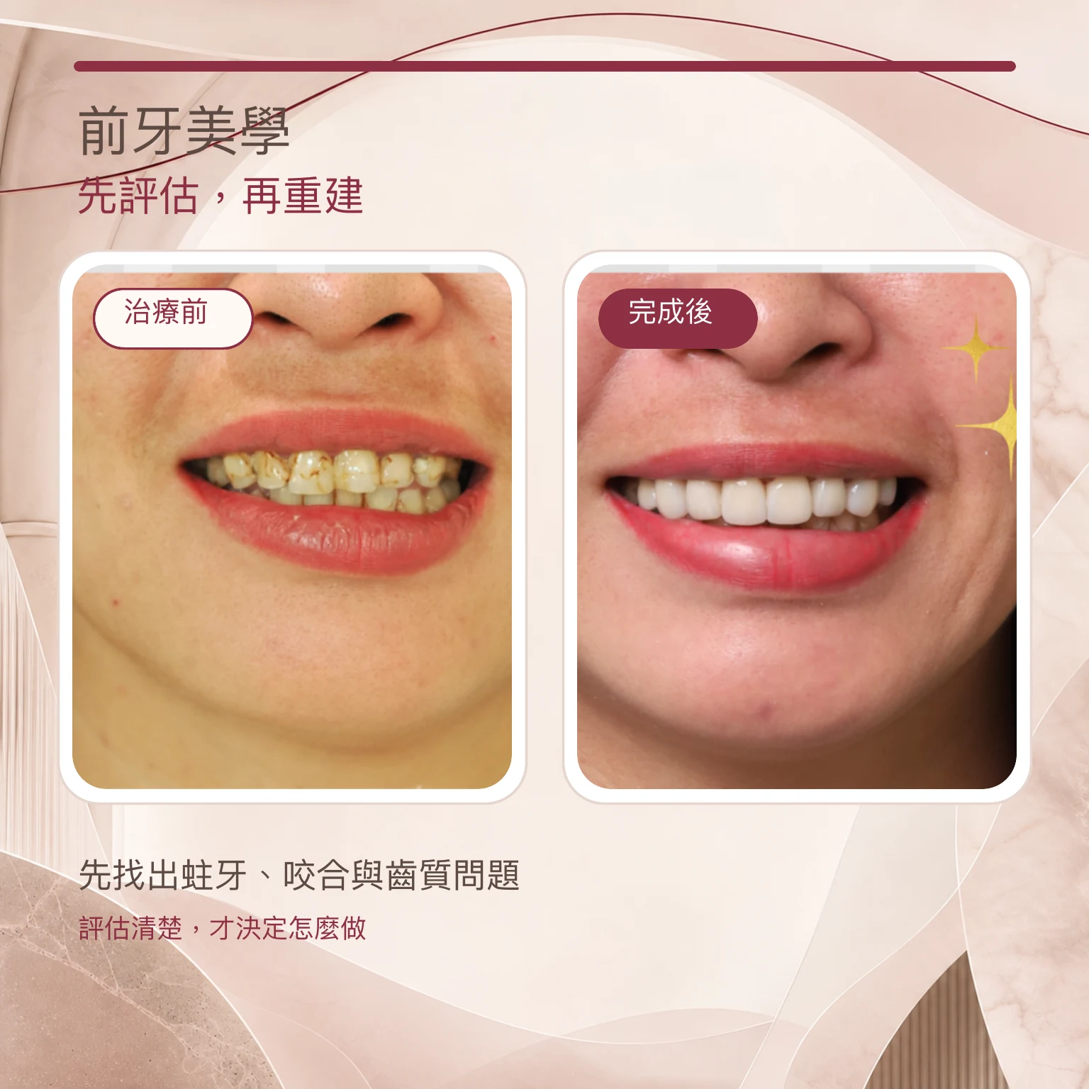 前牙蛀牙美學重建治療前後對照