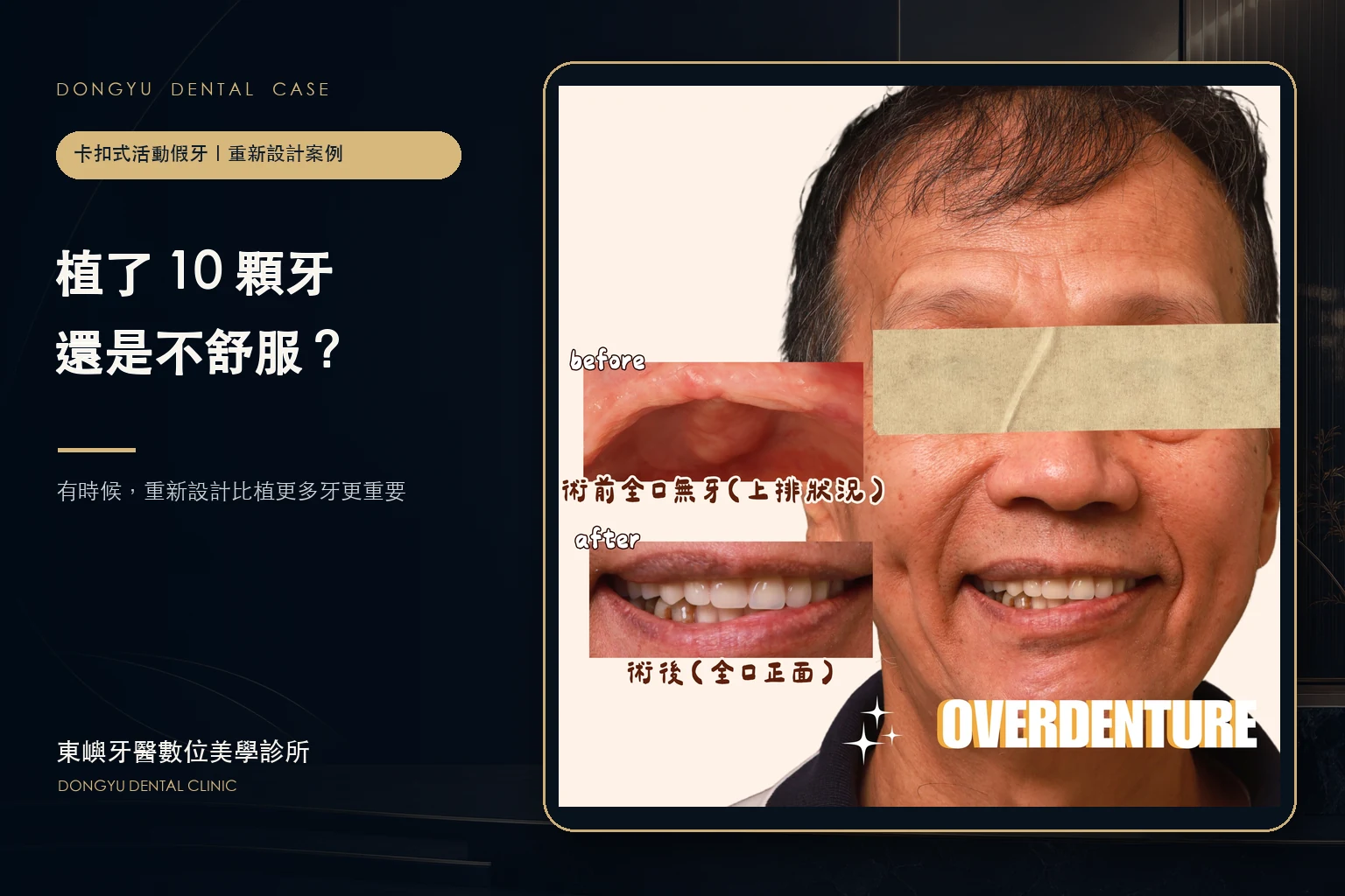 台南卡扣式活動假牙重新設計完整案例封面｜東嶼牙醫數位美學診所
