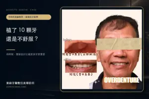 植了 10 顆牙仍不舒服｜他院植牙失敗後卡扣式活動假牙重建案例封面｜東嶼牙醫數位美學診所