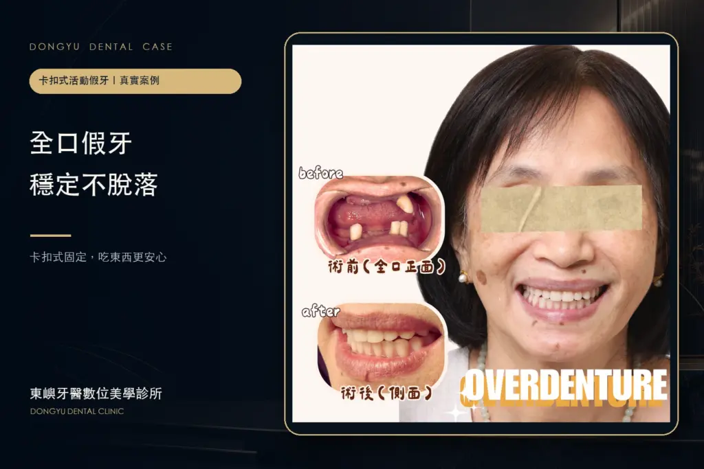 卡扣式固定｜全口假牙穩定不脫落真實案例封面｜東嶼牙醫數位美學診所
