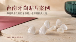 台南牙齒貼片案例｜陶瓷貼片改善門牙磨耗、色澤與微笑比例｜東嶼牙醫數位美學診所
