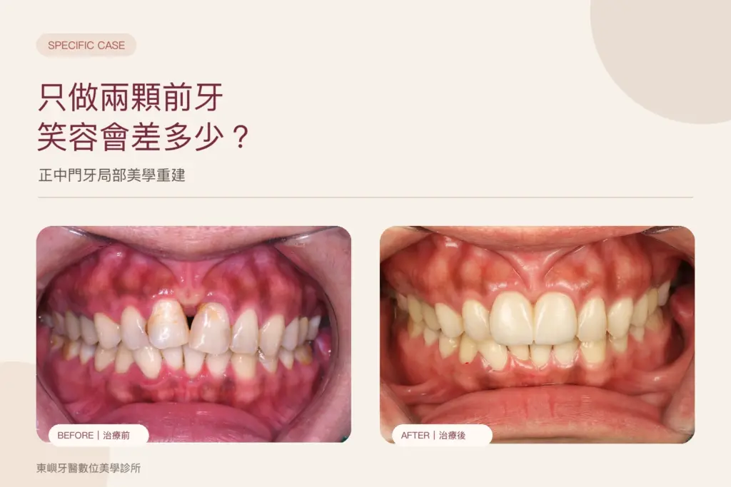 只做兩顆前牙假牙，正中門牙局部美學重建案例封面