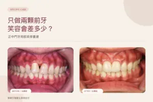 只做兩顆前牙假牙，正中門牙局部美學重建案例封面