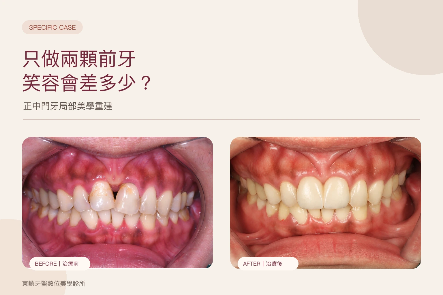 只做兩顆前牙假牙，正中門牙局部美學重建案例封面