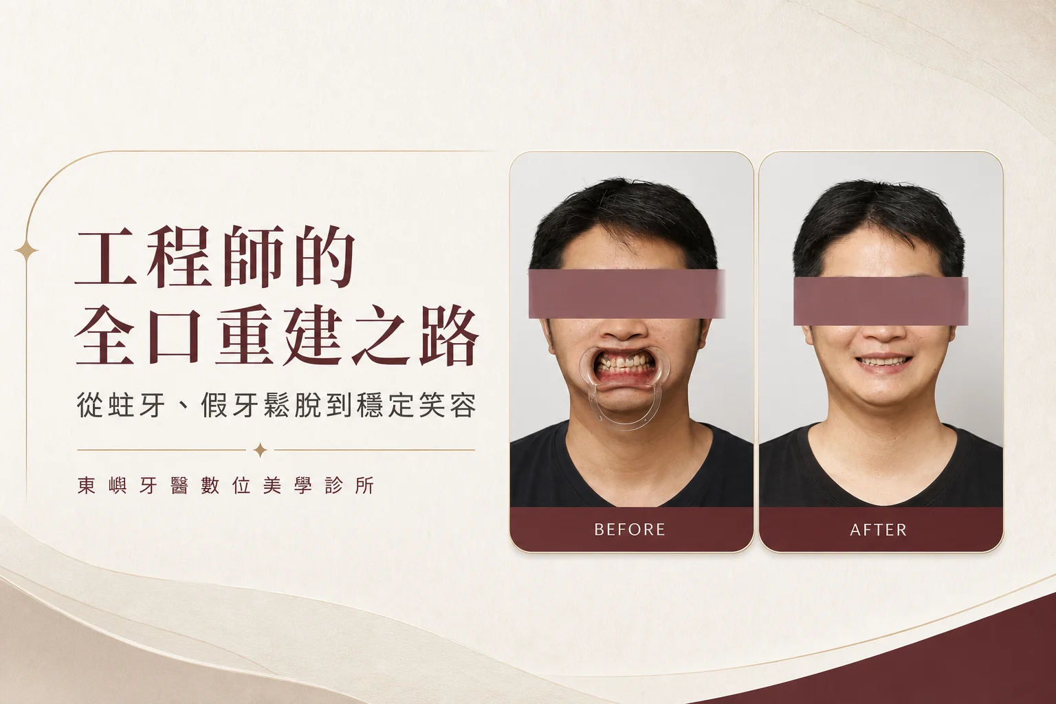工程師數位全口重建案例