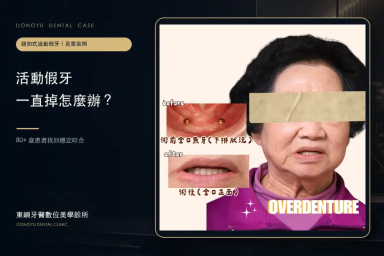 活動假牙一直掉怎麼辦?80+ 歲鈕扣式活動假牙真實案例封面|東嶼牙醫數位美學診所
