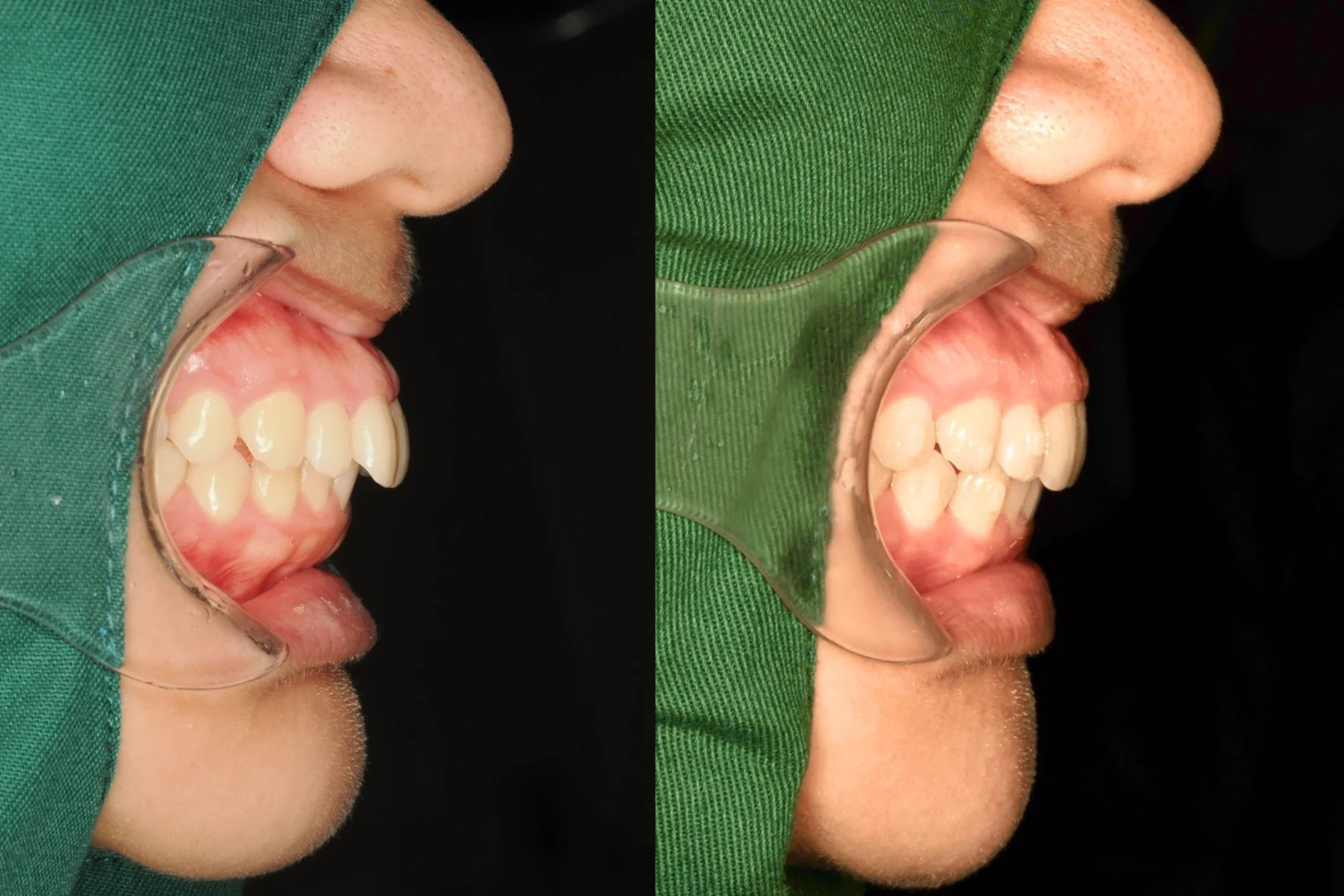 Invisalign 門牙前突與深咬案例側面照前後對照，左為治療前，右為約一年後