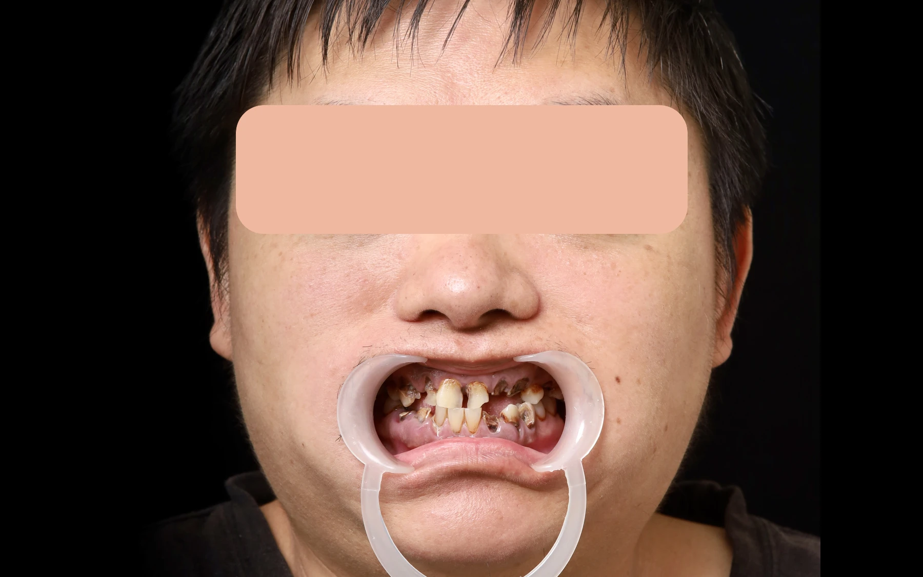多顆牙齒受損患者初診正面紀錄
