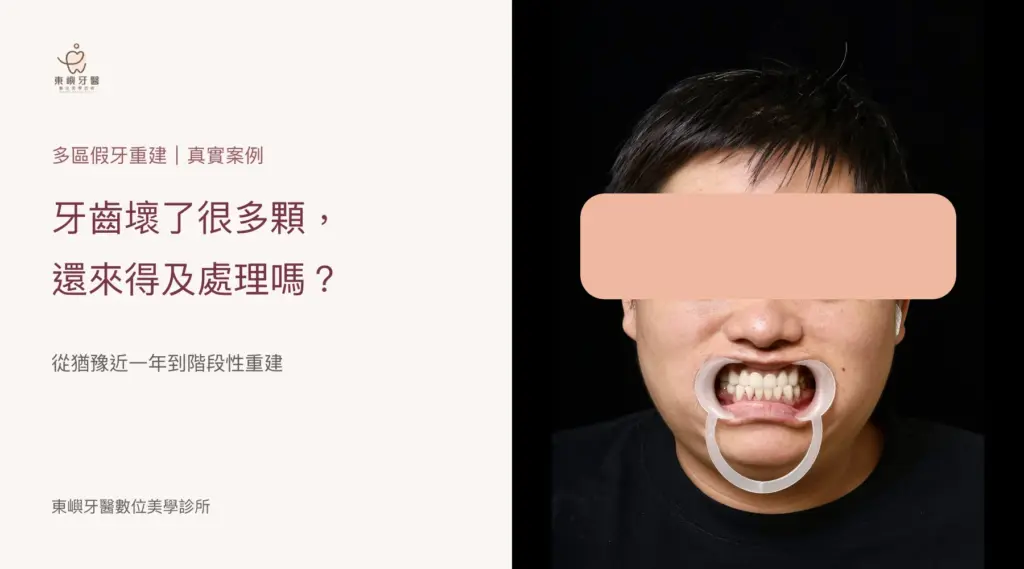 牙齒壞了很多顆多區假牙重建案例封面