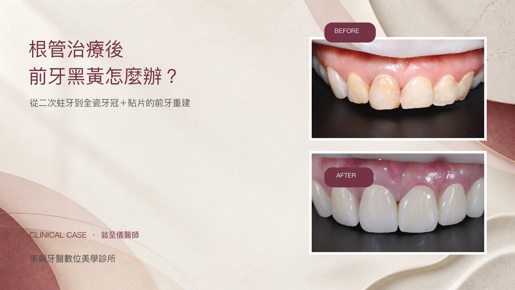 根管治療後前牙黑黃的全瓷牙冠與陶瓷貼片重建案例
