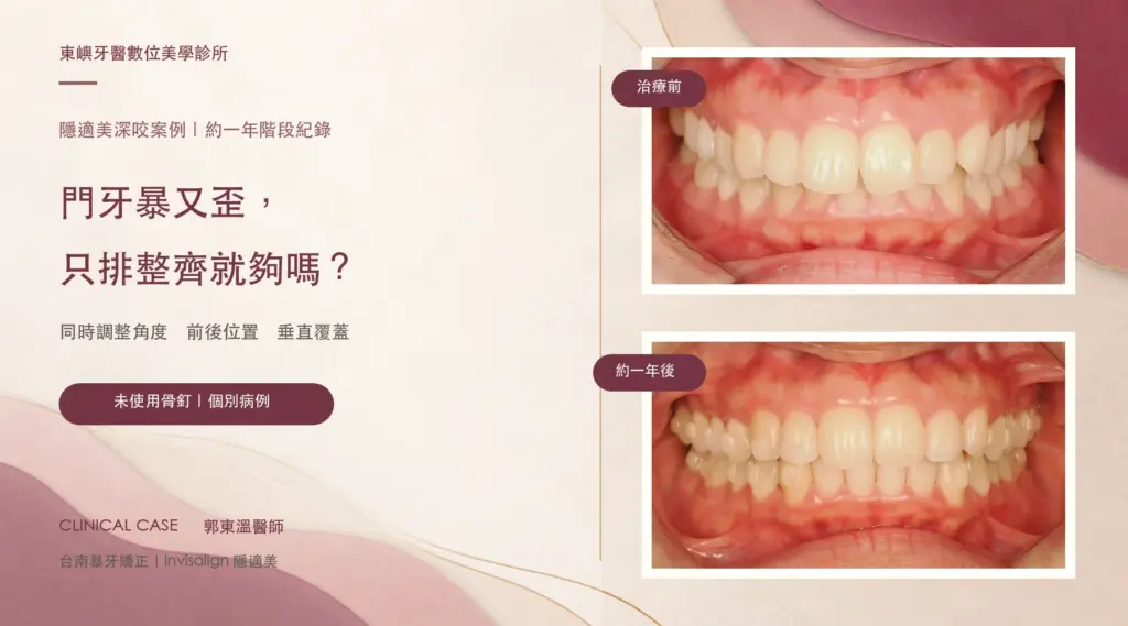 台南暴牙矯正案例封面，隱適美治療前與約一年後口內正面對照