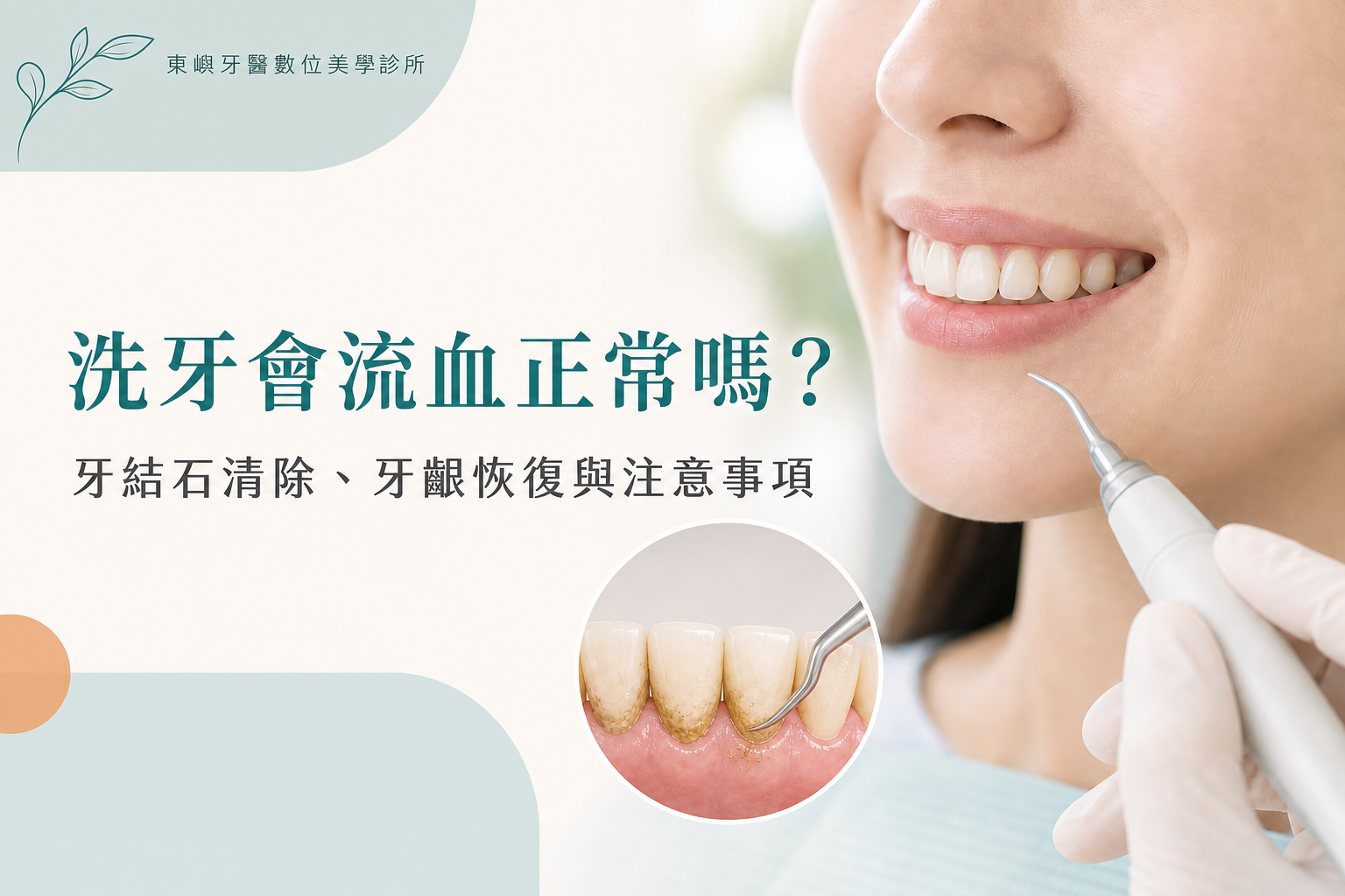 洗牙會流血正常嗎?牙結石清除、牙齦恢復與注意事項|東嶼牙醫數位美學診所